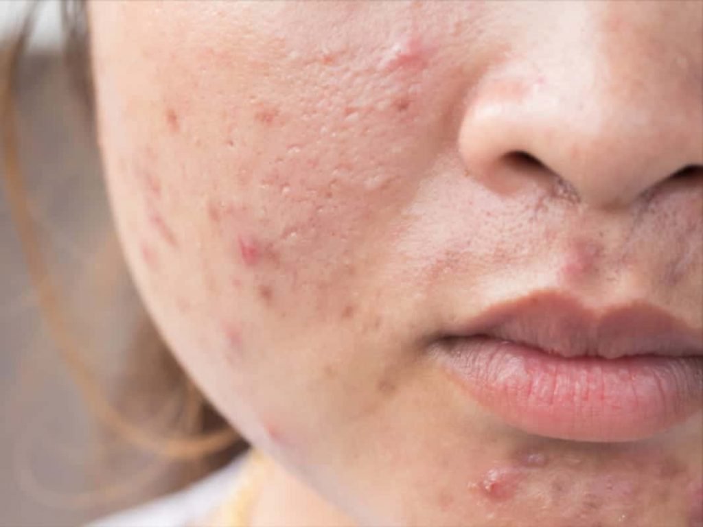 8 Tips to Prevent Acne Caused by Face Masks ('Maskne')